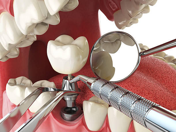 Best Knocked-Out Tooth (Avulsed Tooth) Treatment in St City, AR